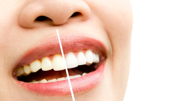 Cara Memutihkan Gigi yang Kuning