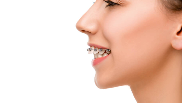 Perawatan Kawat Gigi untuk Gigi Tonggos