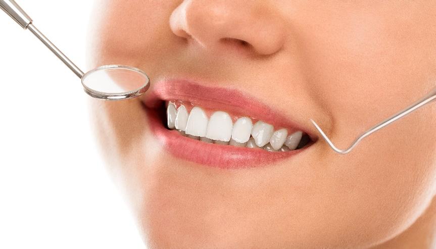 Kegunaan Veneer Gigi dan Hal yang Perlu Anda Ketahui