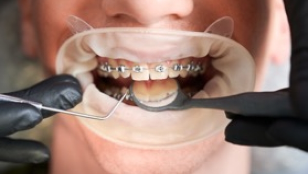 Mengenal Dokter Gigi Spesialis Ortodonti, Apa Tugasnya?