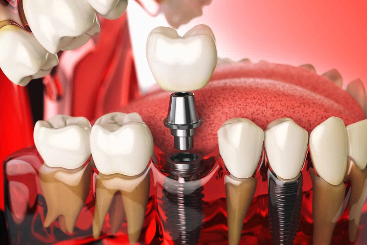 Tooth implant in the model human teeth, gums and denturas. Dental medicine stomatology concept. 3d illustration